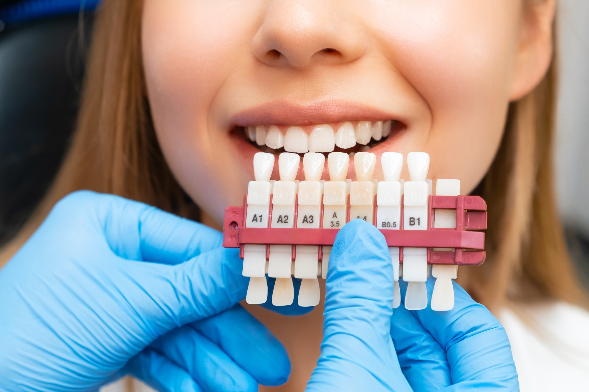 Porcelain Veneers